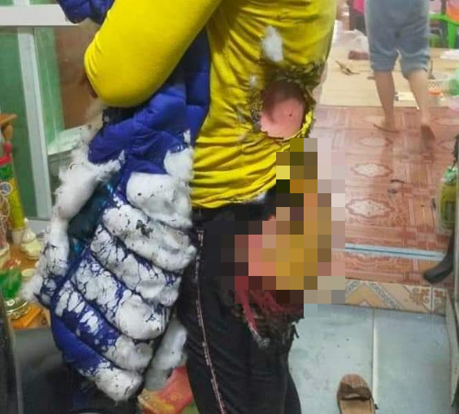 Chị H. đang điều trị tại Hà Nội với một vết bỏng ở toàn bộ chân lên tới lưng và cả 2 tay